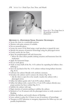 376 Section Four | Head: Eyes, Ears, Nose, and Mouth
METHOD 4—POSTERIOR NASAL PACKING TECHNIQUE
● Secure the client in a comfortable position.
● Monitor with pulse oximetry if available.
● Put on nonsterile gloves.
● Locate the source of the bleed using a nasal speculum to expand the nare.
● Identify the presence of posterior hemorrhage using the pharyngeal mirror.
● Gently suction the site clean.
● Spray the postpharyngeal wall with benzocaine.
●
Advise the client about possible choking sensation and hoarseness from the
medication.
● Apply the fenestrated drape.
● Put on sterile gloves.
● Verify an intact bulb of the No. 14 Fr catheter by expanding the balloon, then
deflating it.
● Sever the tip distal of the No. 14 Fr catheter without losing balloon function
(Fig. 81.5).
● Lubricate the catheter liberally with antibiotic ointment.
● Introduce the catheter until it contacts the choana (Fig. 81.6).
●
Ask the client to open his or her mouth; visualize the catheter with a
pharyngeal mirror.
● Inflate the balloon gently with 5 mL 0.9% sodium chloride.
● Inflate the balloon with a total of 10 to 15 mL 0.9% sodium chloride once
proper position has been verified (Fig. 81.7).
● Stabilize the catheter with tape.
● Begin insertion of anterior packing to stabilize the catheter.
● Recheck in 5 to 10 minutes with the pharyngeal mirror to verify cessation of
bleeding.
● Deflate the balloon, and reverify absence of bleeding.
● Leave catheter in place for 12 hours in case of recurrence of hemorrhage.
● Transport to ENT physician or emergency department for follow-up care and
possible hospitalization.
Figure 81.4 Tie a large knot in
the packing to prevent
dislocation.
4206_Chapter 4_0313-0402.indd 3764206_Chapter 4_0313-0402.indd 376 12/24/2014 2:01:55 PM12/24/2014 2:01:55 PM
Process CyanProcess CyanProcess MagentaProcess MagentaProcess YellowProcess YellowProcess BlackProcess Black
 