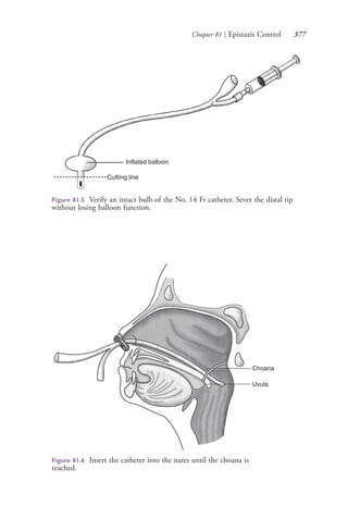 Chapter 81 | Epistaxis Control 377
Cutting line
Inflated balloon
Figure 81.5 Verify an intact bulb of the No. 14 Fr catheter. Sever the distal tip
without losing balloon function.
Choana
Uvula
Figure 81.6 Insert the catheter into the nares until the choana is
reached.
4206_Chapter 4_0313-0402.indd 3774206_Chapter 4_0313-0402.indd 377 12/24/2014 2:01:55 PM12/24/2014 2:01:55 PM
Process CyanProcess CyanProcess MagentaProcess MagentaProcess YellowProcess YellowProcess BlackProcess Black
 