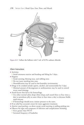 378 Section Four | Head: Eyes, Ears, Nose, and Mouth
Choana
Inflated
balloon
Uvula
Figure 81.7 Inflate the balloon with 5 mL of 0.9% sodium chloride.
Client Instructions
● Activities
●
Avoid strenuous exercise and bending and lifting for 5 days.
● Hygiene
●
Avoid sneezing, blowing nose, and rubbing nose.
●
Do not insert anything into nose.
●
Humidification may be used in low-humidity environments.
● Drugs to be avoided include aspirin, alcohol, and nonsteroidals for 5 days.
●
Minimal amount of decongestant or antihistamines may be used to control
severe nasal drainage.
● Avoid factors that led to the hemorrhage.
●
Use either normal saline drops (three drops each nostril three to four times a
day) or petroleum jelly to nares (three to four times a day) to decrease friable
nasal mucosa.
●
If hemorrhage should recur, initiate pressure to the nares.
● If no relief has occurred, return for more aggressive treatment.
● Anterior nasal packing—as above except avoid sneezing or pulling packing out.
● Observe for signs and symptoms of infection and complications including
●
Fever greater than 99.5°F
●
Increased frequency of headaches
4206_Chapter 4_0313-0402.indd 3784206_Chapter 4_0313-0402.indd 378 12/24/2014 2:01:55 PM12/24/2014 2:01:55 PM
Process CyanProcess CyanProcess MagentaProcess MagentaProcess YellowProcess YellowProcess BlackProcess Black
 