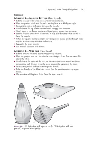 Chapter 83 | Nasal Lavage (Irrigation) 385
Procedure
METHOD 1—SQUEEZE BOTTLE (Fig. 83.1A)
● Fill the squeeze bottle with isotonic/hypertonic solution.
● Have the patient bend over the sink, leaning head at a 45-degree angle.
● Instruct the patient to breathe through the mouth.
● Gently insert the tip of the squeeze bottle snuggly into the nose.
● Slowly squeeze the bottle so that the liquid gently squirts into the nose.
● Let the solution drain from the nostril. It may exit from the other nostril or
from the mouth.
● When the squeeze bottle is empty, have the patient exhale gently through both
nostrils to clear excess solution and mucus.
● Repeat in the other nostril.
● Use one full bottle in each nostril.
METHOD 2—NETI POT (Fig. 83.1B)
● Fill the neti pot with the isotonic/hypertonic solution.
● Have the patient lean over the sink (about 45 degrees), so that one nostril is
above the other.
● Gently insert the spout of the neti pot into the uppermost nostril to form a
comfortable seal. Do not press the spout against the septum of the nose.
● Instruct the patient to breathe through the mouth.
● Raise the handle of the filled neti pot so that the solution enters the upper
nostril.
● The solution will begin to drain from the lower nostril.
Figure 83.1 (A) Irrigation with squeeze bottle; (B) irrigation with neti
pot; (C) irrigation with syringe.
A
B
C
4206_Chapter 4_0313-0402.indd 3854206_Chapter 4_0313-0402.indd 385 12/24/2014 2:01:55 PM12/24/2014 2:01:55 PM
Process CyanProcess CyanProcess MagentaProcess MagentaProcess YellowProcess YellowProcess BlackProcess Black
 