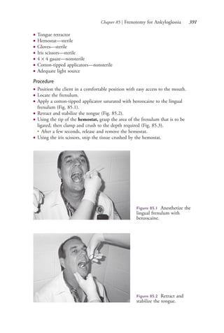 Chapter 85 | Frenotomy for Ankyloglossia 391
● Tongue retractor
● Hemostat—sterile
● Gloves—sterile
● Iris scissors—sterile
● 4 × 4 gauze—nonsterile
● Cotton-tipped applicators—nonsterile
● Adequate light source
Procedure
● Position the client in a comfortable position with easy access to the mouth.
● Locate the frenulum.
● Apply a cotton-tipped applicator saturated with benzocaine to the lingual
frenulum (Fig. 85.1).
● Retract and stabilize the tongue (Fig. 85.2).
● Using the tip of the hemostat, grasp the area of the frenulum that is to be
ligated, then clamp and crush to the depth required (Fig. 85.3).
●
After a few seconds, release and remove the hemostat.
● Using the iris scissors, snip the tissue crushed by the hemostat.
Figure 85.1 Anesthetize the
lingual frenulum with
benzocaine.
Figure 85.2 Retract and
stabilize the tongue.
4206_Chapter 4_0313-0402.indd 3914206_Chapter 4_0313-0402.indd 391 12/24/2014 2:01:55 PM12/24/2014 2:01:55 PM
Process CyanProcess CyanProcess MagentaProcess MagentaProcess YellowProcess YellowProcess BlackProcess Black
 