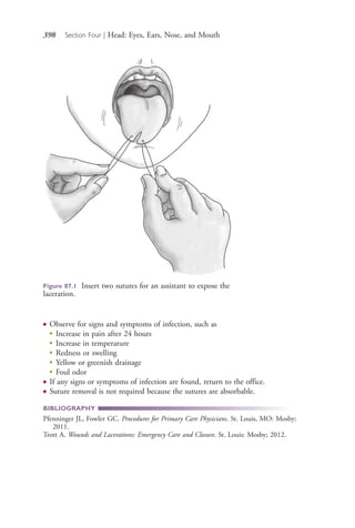 398 Section Four | Head: Eyes, Ears, Nose, and Mouth
● Observe for signs and symptoms of infection, such as
●
Increase in pain after 24 hours
●
Increase in temperature
●
Redness or swelling
●
Yellow or greenish drainage
●
Foul odor
● If any signs or symptoms of infection are found, return to the office.
● Suture removal is not required because the sutures are absorbable.
BIBLIOGRAPHY
Pfenninger JL, Fowler GC. Procedures for Primary Care Physicians. St. Louis, MO: Mosby;
2011.
Trott A. Wounds and Lacerations: Emergency Care and Closure. St. Louis: Mosby; 2012.
Figure 87.1 Insert two sutures for an assistant to expose the
laceration.
4206_Chapter 4_0313-0402.indd 3984206_Chapter 4_0313-0402.indd 398 12/24/2014 2:01:56 PM12/24/2014 2:01:56 PM
Process CyanProcess CyanProcess MagentaProcess MagentaProcess YellowProcess YellowProcess BlackProcess Black
 