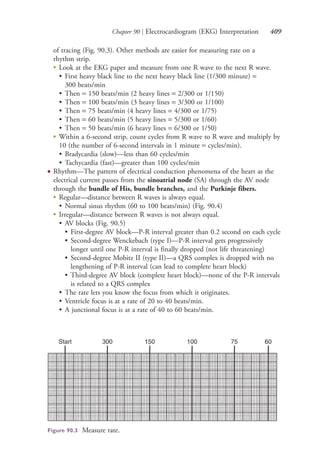Chapter 90 | Electrocardiogram (EKG) Interpretation 409
of tracing (Fig. 90.3). Other methods are easier for measuring rate on a
rhythm strip.
●
Look at the EKG paper and measure from one R wave to the next R wave.
• First heavy black line to the next heavy black line (1/300 minute) =
300 beats/min
• Then = 150 beats/min (2 heavy lines = 2/300 or 1/150)
• Then = 100 beats/min (3 heavy lines = 3/300 or 1/100)
• Then = 75 beats/min (4 heavy lines = 4/300 or 1/75)
• Then = 60 beats/min (5 heavy lines = 5/300 or 1/60)
• Then = 50 beats/min (6 heavy lines = 6/300 or 1/50)
●
Within a 6-second strip, count cycles from R wave to R wave and multiply by
10 (the number of 6-second intervals in 1 minute = cycles/min).
• Bradycardia (slow)—less than 60 cycles/min
• Tachycardia (fast)—greater than 100 cycles/min
● Rhythm—The pattern of electrical conduction phenomena of the heart as the
electrical current passes from the sinoatrial node (SA) through the AV node
through the bundle of His, bundle branches, and the Purkinje fibers.
●
Regular—distance between R waves is always equal.
• Normal sinus rhythm (60 to 100 beats/min) (Fig. 90.4)
●
Irregular—distance between R waves is not always equal.
• AV blocks (Fig. 90.5)
• First-degree AV block—P-R interval greater than 0.2 second on each cycle
• Second-degree Wenckebach (type I)—P-R interval gets progressively
longer until one P-R interval is finally dropped (not life threatening)
• Second-degree Mobitz II (type II)—a QRS complex is dropped with no
lengthening of P-R interval (can lead to complete heart block)
• Third-degree AV block (complete heart block)—none of the P-R intervals
is related to a QRS complex
• The rate lets you know the focus from which it originates.
• Ventricle focus is at a rate of 20 to 40 beats/min.
• A junctional focus is at a rate of 40 to 60 beats/min.
Figure 90.3 Measure rate.
4206_Chapter 5_.indd 4094206_Chapter 5_.indd 409 12/24/2014 2:30:59 PM12/24/2014 2:30:59 PM
Process CyanProcess CyanProcess MagentaProcess MagentaProcess YellowProcess YellowProcess BlackProcess Black
 