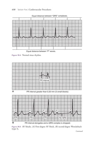 410 Section Five | Cardiovascular Procedures
Figure 90.4 Normal sinus rhythm.
Figure 90.5 AV blocks. (A) First-degree AV block, (B) second-degree Wenckebach
(type I),
A
B
Continued
4206_Chapter 5_.indd 4104206_Chapter 5_.indd 410 12/24/2014 2:30:59 PM12/24/2014 2:30:59 PM
Process CyanProcess CyanProcess MagentaProcess MagentaProcess YellowProcess YellowProcess BlackProcess Black
 