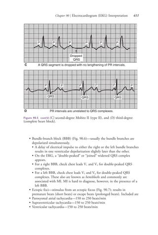 Chapter 90 | Electrocardiogram (EKG) Interpretation 411
• Bundle-branch block (BBB) (Fig. 90.6)—usually the bundle branches are
depolarized simultaneously.
• A delay of electrical impulse to either the right or the left bundle branches
results in one ventricular depolarization slightly later than the other.
• On the EKG, a “double-peaked” or “joined” widened QRS complex
appears.
• For a right BBB, check chest leads V1 and V2 for double-peaked QRS
complexes.
• For a left BBB, check chest leads V5 and V6 for double-peaked QRS
complexes. These also are known as hemiblocks and commonly are
associated with MI. MI is hard to diagnose, however, in the presence of a
left BBB.
• Ectopic foci—stimulus from an ectopic focus (Fig. 90.7); results in
premature beats (short beats) or escape beats (prolonged beats). Included are
• Paroxysmal atrial tachycardia—150 to 250 beats/min
• Supraventricular tachycardia—150 to 250 beats/min
• Ventricular tachycardia—150 to 250 beats/min
C
D
Figure 90.5 cont’d (C) second-degree Mobitz II (type II), and (D) third-degree
(complete heart block).
4206_Chapter 5_.indd 4114206_Chapter 5_.indd 411 12/24/2014 2:30:59 PM12/24/2014 2:30:59 PM
Process CyanProcess CyanProcess MagentaProcess MagentaProcess YellowProcess YellowProcess BlackProcess Black
 