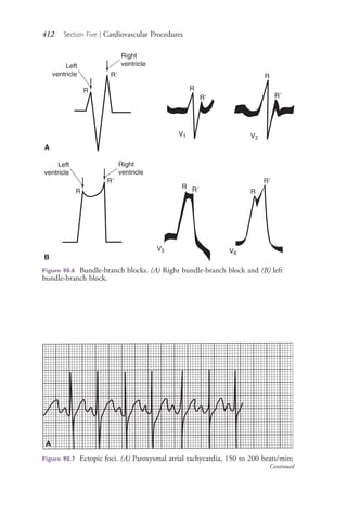 412 Section Five | Cardiovascular Procedures
Figure 90.6 Bundle-branch blocks. (A) Right bundle-branch block and (B) left
bundle-branch block.
A
B
A
Figure 90.7 Ectopic foci. (A) Paroxysmal atrial tachycardia, 150 to 200 beats/min;
Continued
4206_Chapter 5_.indd 4124206_Chapter 5_.indd 412 12/24/2014 2:30:59 PM12/24/2014 2:30:59 PM
Process CyanProcess CyanProcess MagentaProcess MagentaProcess YellowProcess YellowProcess BlackProcess Black
 