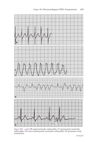 Chapter 90 | Electrocardiogram (EKG) Interpretation 413
B
C
D
E
Figure 90.7 cont’d (B) supraventricular tachycardia; (C) paroxysmal ventricular
tachycardia; (D) runs of paroxysmal ventricular tachycardia; (E) premature atrial
contraction;
Continued
4206_Chapter 5_.indd 4134206_Chapter 5_.indd 413 12/24/2014 2:30:59 PM12/24/2014 2:30:59 PM
Process CyanProcess CyanProcess MagentaProcess MagentaProcess YellowProcess YellowProcess BlackProcess Black
 