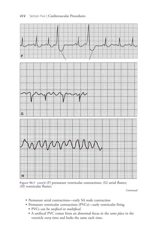 414 Section Five | Cardiovascular Procedures
F
G
• Premature atrial contractions—early SA node contraction
• Premature ventricular contractions (PVCs)—early ventricular firing
• PVCs can be unifocal or multifocal.
• A unifocal PVC comes from an abnormal focus in the same place in the
ventricle every time and looks the same each time.
H
Figure 90.7 cont’d (F) premature ventricular contractions; (G) atrial flutter;
(H) ventricular flutter;
Continued
4206_Chapter 5_.indd 4144206_Chapter 5_.indd 414 12/24/2014 2:31:00 PM12/24/2014 2:31:00 PM
Process CyanProcess CyanProcess MagentaProcess MagentaProcess YellowProcess YellowProcess BlackProcess Black
 
