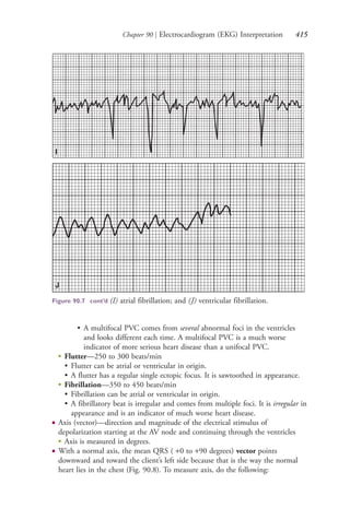 Chapter 90 | Electrocardiogram (EKG) Interpretation 415
I
J
Figure 90.7 cont’d (I) atrial fibrillation; and (J) ventricular fibrillation.
• A multifocal PVC comes from several abnormal foci in the ventricles
and looks different each time. A multifocal PVC is a much worse
indicator of more serious heart disease than a unifocal PVC.
●
Flutter—250 to 300 beats/min
• Flutter can be atrial or ventricular in origin.
• A flutter has a regular single ectopic focus. It is sawtoothed in appearance.
●
Fibrillation—350 to 450 beats/min
• Fibrillation can be atrial or ventricular in origin.
• A fibrillatory beat is irregular and comes from multiple foci. It is irregular in
appearance and is an indicator of much worse heart disease.
● Axis (vector)—direction and magnitude of the electrical stimulus of
depolarization starting at the AV node and continuing through the ventricles
●
Axis is measured in degrees.
● With a normal axis, the mean QRS ( +0 to +90 degrees) vector points
downward and toward the client’s left side because that is the way the normal
heart lies in the chest (Fig. 90.8). To measure axis, do the following:
4206_Chapter 5_.indd 4154206_Chapter 5_.indd 415 12/24/2014 2:31:00 PM12/24/2014 2:31:00 PM
Process CyanProcess CyanProcess MagentaProcess MagentaProcess YellowProcess YellowProcess BlackProcess Black
 