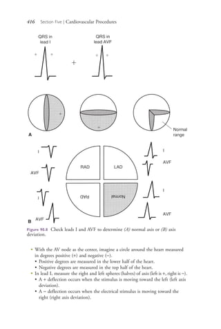 416 Section Five | Cardiovascular Procedures
●
With the AV node as the center, imagine a circle around the heart measured
in degrees positive (+) and negative (−).
• Positive degrees are measured in the lower half of the heart.
• Negative degrees are measured in the top half of the heart.
●
In lead I, measure the right and left spheres (halves) of axis (left is +, right is −).
• A + deflection occurs when the stimulus is moving toward the left (left axis
deviation).
• A − deflection occurs when the electrical stimulus is moving toward the
right (right axis deviation).
Figure 90.8 Check leads I and AVF to determine (A) normal axis or (B) axis
deviation.
A
B
4206_Chapter 5_.indd 4164206_Chapter 5_.indd 416 12/24/2014 2:31:00 PM12/24/2014 2:31:00 PM
Process CyanProcess CyanProcess MagentaProcess MagentaProcess YellowProcess YellowProcess BlackProcess Black
 