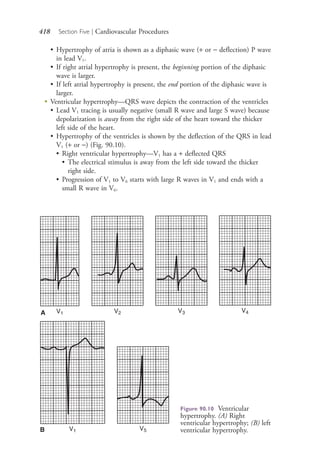 418 Section Five | Cardiovascular Procedures
• Hypertrophy of atria is shown as a diphasic wave (+ or − deflection) P wave
in lead V1.
• If right atrial hypertrophy is present, the beginning portion of the diphasic
wave is larger.
• If left atrial hypertrophy is present, the end portion of the diphasic wave is
larger.
●
Ventricular hypertrophy—QRS wave depicts the contraction of the ventricles
• Lead V1 tracing is usually negative (small R wave and large S wave) because
depolarization is away from the right side of the heart toward the thicker
left side of the heart.
• Hypertrophy of the ventricles is shown by the deflection of the QRS in lead
V1 (+ or −) (Fig. 90.10).
• Right ventricular hypertrophy—V1 has a + deflected QRS
• The electrical stimulus is away from the left side toward the thicker
right side.
• Progression of V1 to V6 starts with large R waves in V1 and ends with a
small R wave in V6.
Figure 90.10 Ventricular
hypertrophy. (A) Right
ventricular hypertrophy; (B) left
ventricular hypertrophy.
A
B
4206_Chapter 5_.indd 4184206_Chapter 5_.indd 418 12/24/2014 2:31:00 PM12/24/2014 2:31:00 PM
Process CyanProcess CyanProcess MagentaProcess MagentaProcess YellowProcess YellowProcess BlackProcess Black
 