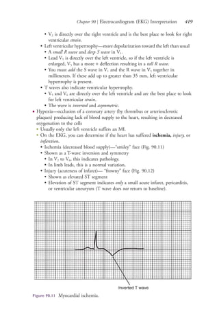 Chapter 90 | Electrocardiogram (EKG) Interpretation 419
• V2 is directly over the right ventricle and is the best place to look for right
ventricular strain.
• Left ventricular hypertrophy—more depolarization toward the left than usual
• A small R wave and deep S wave in V1.
• Lead V5 is directly over the left ventricle, so if the left ventricle is
enlarged, V5 has a more + deflection resulting in a tall R wave.
• You must add the S wave in V1 and the R wave in V5 together in
millimeters. If these add up to greater than 35 mm, left ventricular
hypertrophy is present.
• T waves also indicate ventricular hypertrophy.
• V5 and V6 are directly over the left ventricle and are the best place to look
for left ventricular strain.
• The wave is inverted and asymmetric.
● Hypoxia—occlusion of a coronary artery (by thrombus or arteriosclerotic
plaques) producing lack of blood supply to the heart, resulting in decreased
oxygenation to the cells
●
Usually only the left ventricle suffers an MI.
●
On the EKG, you can determine if the heart has suffered ischemia, injury, or
infarction.
• Ischemia (decreased blood supply)—“smiley” face (Fig. 90.11)
• Shown as a T-wave inversion and symmetry
• In V2 to V6, this indicates pathology.
• In limb leads, this is a normal variation.
• Injury (acuteness of infarct)— “frowny” face (Fig. 90.12)
• Shown as elevated ST segment
• Elevation of ST segment indicates only a small acute infarct, pericarditis,
or ventricular aneurysm (T wave does not return to baseline).
Figure 90.11 Myocardial ischemia.
4206_Chapter 5_.indd 4194206_Chapter 5_.indd 419 12/24/2014 2:31:00 PM12/24/2014 2:31:00 PM
Process CyanProcess CyanProcess MagentaProcess MagentaProcess YellowProcess YellowProcess BlackProcess Black
 