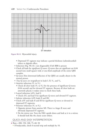 420 Section Five | Cardiovascular Procedures
• Depressed ST segment may indicate a partial-thickness (subendocardial)
infarct or digitalis effect.
• Infarction (Fig. 90.13)—not diagnosable if left BBB is present
• Check all leads for significant Q waves. Q waves that are significant are 0.04
second (one small square) wide or one-third amplitude of the entire QRS
complex.
• Q waves (first downward deflection of the QRS) are usually absent in the
normal person.
• Tiny Q waves are insignificant in leads I, II, V5, and V6.
• Anterior infarction (V1 to V4)
• Check all chest leads (V1 to V4) for the presence of significant Q waves
(0.04 second) and for elevated ST segment. Because all chest leads are
anteriorly placed, it makes sense to check these leads.
• Lateral infarction (aVL, lead I)
• Check aVL and lead I for significant Q waves and elevated ST segment.
• Inferior infarction (aVF, leads II and III)
• Check aVF and leads II and III for significant Q waves or elevated or
depressed ST segments.
• Posterior infarction (V1 to V2)
• Opposite picture from anterior MI. There is a larger R wave and
obviously depressed ST segment.
• Do the mirror test. Turn the EKG upside down and look at it in a mirror.
It should look like the classic acute infarct.
QUICK AND EASY INTERPRETATION
● Rate—300, 150, 100, 75, 60, 50
●
If bradycardia, check 6-second strip and multiply by 10.
Figure 90.12 Myocardial injury.
4206_Chapter 5_.indd 4204206_Chapter 5_.indd 420 12/24/2014 2:31:00 PM12/24/2014 2:31:00 PM
Process CyanProcess CyanProcess MagentaProcess MagentaProcess YellowProcess YellowProcess BlackProcess Black
 