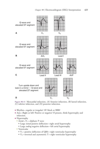 Chapter 90 | Electrocardiogram (EKG) Interpretation 421
● Rhythm—regular or irregular? AV block or BBB?
● Axis—Right or left? Positive or negative? If present, think hypertrophy and
infarction.
● Hypertrophy
●
Atrial—V1—diphasic P wave
• Large initial positive deflection—right atrial hypertrophy
• Large ending negative deflection—left atrial hypertrophy
●
Ventricular
• V1—positive deflection of QRS—right ventricular hypertrophy
• V2—inverted and asymmetric T—right ventricular hypertrophy
A
B
C
D
Figure 90.13 Myocardial infarction. (A) Anterior infarction, (B) lateral infarction,
(C) inferior infarction, and (D) posterior infarction.
4206_Chapter 5_.indd 4214206_Chapter 5_.indd 421 12/24/2014 2:31:00 PM12/24/2014 2:31:00 PM
Process CyanProcess CyanProcess MagentaProcess MagentaProcess YellowProcess YellowProcess BlackProcess Black
 