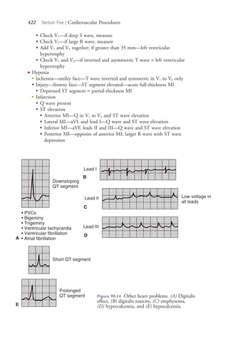422 Section Five | Cardiovascular Procedures
• Check V1—if deep S wave, measure
• Check V5—if large R wave, measure
• Add V1 and V5 together; if greater than 35 mm—left ventricular
hypertrophy
• Check V5 and V6—if inverted and asymmetric T wave = left ventricular
hypertrophy
● Hypoxia
●
Ischemia—smiley face—T wave inverted and symmetric in V1 to V6 only
• Injury—frowny face—ST segment elevated—acute full-thickness MI
• Depressed ST segment = partial-thickness MI
●
Infarction
• Q wave present
• ST elevation
• Anterior MI—Q in V1 to V4 and ST wave elevation
• Lateral MI—aVL and lead I—Q wave and ST wave elevation
• Inferior MI—aVF, leads II and III—Q wave and ST wave elevation
• Posterior MI—opposite of anterior MI; larger R wave with ST wave
depression
A
B
C
D
E
Figure 90.14 Other heart problems. (A) Digitalis
effect, (B) digitalis toxicity, (C) emphysema,
(D) hypercalcemia, and (E) hypocalcemia.
4206_Chapter 5_.indd 4224206_Chapter 5_.indd 422 12/24/2014 2:31:00 PM12/24/2014 2:31:00 PM
Process CyanProcess CyanProcess MagentaProcess MagentaProcess YellowProcess YellowProcess BlackProcess Black
 