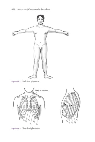 426 Section Five | Cardiovascular Procedures
Figure 91.1 Limb lead placement.
Body of sternum
V1
V2
V3
V4
V5
V6
V2
V3 V4
V5
V6
Figure 91.2 Chest lead placement.
4206_Chapter 5_.indd 4264206_Chapter 5_.indd 426 12/24/2014 2:31:01 PM12/24/2014 2:31:01 PM
Process CyanProcess CyanProcess MagentaProcess MagentaProcess YellowProcess YellowProcess BlackProcess Black
 