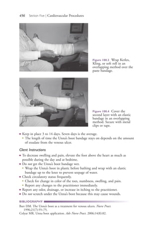 456 Section Five | Cardiovascular Procedures
● Keep in place 3 to 14 days. Seven days is the average.
●
The length of time the Unna’s boot bandage stays on depends on the amount
of exudate from the venous ulcer.
Client Instructions
● To decrease swelling and pain, elevate the foot above the heart as much as
possible during the day and at bedtime.
● Do not get the Unna’s boot bandage wet.
●
Wrap the Unna’s boot in plastic before bathing and wrap with an elastic
bandage up to the knee to prevent seepage of water.
● Check circulatory status frequently.
●
Check for change in color of the toes, numbness, swelling, and pain.
●
Report any changes to the practitioner immediately.
● Report any odor, drainage, or increase in itching to the practitioner.
● Do not scratch under the Unna’s boot because this may cause wounds.
BIBLIOGRAPHY
Barr DM. The Unna’s boot as a treatment for venous ulcers. Nurse Pract.
1996;21(7):55–75.
Colyar MR. Unna boot application. Adv Nurse Pract. 2006;14(8):82.
Figure 100.3 Wrap Kerlex,
Kling, or soft roll in an
overlapping method over the
paste bandage.
Figure 100.4 Cover the
second layer with an elastic
bandage in an overlapping
method. Secure with metal
clips or tape.
4206_Chapter 5_.indd 4564206_Chapter 5_.indd 456 12/24/2014 2:31:02 PM12/24/2014 2:31:02 PM
Process CyanProcess CyanProcess MagentaProcess MagentaProcess YellowProcess YellowProcess BlackProcess Black
 
