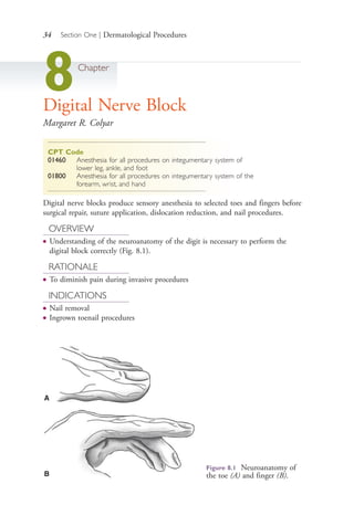 34 Section One | Dermatological Procedures
8Chapter
Digital Nerve Block
Margaret R. Colyar
CPT Code
01460 Anesthesia for all procedures on integumentary system of
lower leg, ankle, and foot
01800 Anesthesia for all procedures on integumentary system of the
forearm, wrist, and hand
Digital nerve blocks produce sensory anesthesia to selected toes and fingers before
surgical repair, suture application, dislocation reduction, and nail procedures.
OVERVIEW
● Understanding of the neuroanatomy of the digit is necessary to perform the
digital block correctly (Fig. 8.1).
RATIONALE
● To diminish pain during invasive procedures
INDICATIONS
● Nail removal
● Ingrown toenail procedures
Figure 8.1 Neuroanatomy of
the toe (A) and finger (B).
A
B
4206_Chapter 1_0001-0120.indd 344206_Chapter 1_0001-0120.indd 34 12/24/2014 2:01:16 PM12/24/2014 2:01:16 PM
Process CyanProcess CyanProcess MagentaProcess MagentaProcess YellowProcess YellowProcess BlackProcess Black
 