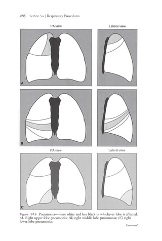 486 Section Six | Respiratory Procedures
Figure 107.6 Pneumonia—more white and less black in whichever lobe is affected.
(A) Right upper lobe pneumonia; (B) right middle lobe pneumonia; (C) right
lower lobe pneumonia;
A
B
C
Continued
4206_Chapter 6_.indd 4864206_Chapter 6_.indd 486 12/24/2014 2:30:45 PM12/24/2014 2:30:45 PM
Process CyanProcess CyanProcess MagentaProcess MagentaProcess YellowProcess YellowProcess BlackProcess Black
 