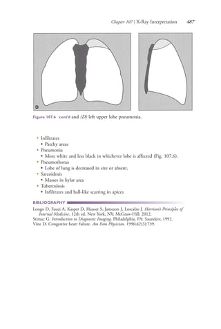Chapter 107 | X-Ray Interpretation 487
●
Infiltrates
• Patchy areas
●
Pneumonia
• More white and less black in whichever lobe is affected (Fig. 107.6).
●
Pneumothorax
• Lobe of lung is decreased in size or absent.
●
Sarcoidosis
• Masses in hylar area
●
Tuberculosis
• Infiltrates and ball-like scarring in apices
BIBLIOGRAPHY
Longo D, Fauci A, Kasper D, Hauser S, Jameson J, Loscalzo J. Harrison’s Principles of
Internal Medicine. 12th ed. New York, NY: McGraw-Hill; 2012.
Stimac G. Introduction to Diagnostic Imaging. Philadelphia, PA: Saunders; 1992.
Vine D. Congestive heart failure. Am Fam Physician. 1990;42(3):739.
D
Figure 107.6 cont’d and (D) left upper lobe pneumonia.
D
4206_Chapter 6_.indd 4874206_Chapter 6_.indd 487 12/24/2014 2:30:45 PM12/24/2014 2:30:45 PM
Process CyanProcess CyanProcess MagentaProcess MagentaProcess YellowProcess YellowProcess BlackProcess Black
 