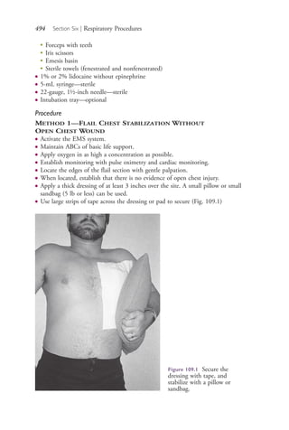 494 Section Six | Respiratory Procedures
●
Forceps with teeth
●
Iris scissors
●
Emesis basin
●
Sterile towels (fenestrated and nonfenestrated)
● 1% or 2% lidocaine without epinephrine
● 5-mL syringe—sterile
● 22-gauge, 1½-inch needle—sterile
● Intubation tray—optional
Procedure
METHOD 1—FLAIL CHEST STABILIZATION WITHOUT
OPEN CHEST WOUND
● Activate the EMS system.
● Maintain ABCs of basic life support.
● Apply oxygen in as high a concentration as possible.
● Establish monitoring with pulse oximetry and cardiac monitoring.
● Locate the edges of the flail section with gentle palpation.
● When located, establish that there is no evidence of open chest injury.
● Apply a thick dressing of at least 3 inches over the site. A small pillow or small
sandbag (5 lb or less) can be used.
● Use large strips of tape across the dressing or pad to secure (Fig. 109.1)
Figure 109.1 Secure the
dressing with tape, and
stabilize with a pillow or
sandbag.
4206_Chapter 6_.indd 4944206_Chapter 6_.indd 494 12/24/2014 2:30:46 PM12/24/2014 2:30:46 PM
Process CyanProcess CyanProcess MagentaProcess MagentaProcess YellowProcess YellowProcess BlackProcess Black
 