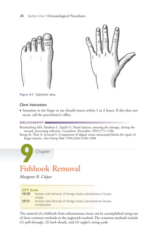 36 Section One | Dermatological Procedures
Client Instructions
● Sensation to the finger or toe should return within 1 to 2 hours. If this does not
occur, call the practitioner’s office.
BIBLIOGRAPHY
Brandenberg MA, Hawkins L, Quick G. Hand injuries: assessing the damage, closing the
wound, preventing infection. Consultant. December 1995:1777–1786.
Kroop K, Trott A, Syverud S. Comparison of digital versus metacarpal blocks for repair of
finger injuries. Ann Emerg Med. 1994;23(6):1296–1300.
9Chapter
Fishhook Removal
Margaret R. Colyar
CPT Code
10120 Incision and removal of foreign body, subcutaneous tissues;
simple
10121 Incision and removal of foreign body, subcutaneous tissues;
complicated
The removal of a fishhook from subcutaneous tissue can be accomplished using one
of three common methods or the angiocath method. The common methods include
(1) pull-through, (2) barb sheath, and (3) angler’s string-yank.
Figure 8.2 Injection sites.
4206_Chapter 1_0001-0120.indd 364206_Chapter 1_0001-0120.indd 36 12/24/2014 2:01:16 PM12/24/2014 2:01:16 PM
Process CyanProcess CyanProcess MagentaProcess MagentaProcess YellowProcess YellowProcess BlackProcess Black
 