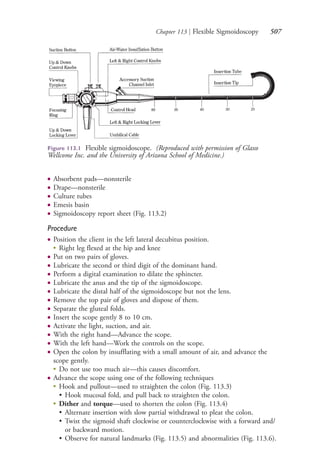 Chapter 113 | Flexible Sigmoidoscopy 507
● Absorbent pads—nonsterile
● Drape—nonsterile
● Culture tubes
● Emesis basin
● Sigmoidoscopy report sheet (Fig. 113.2)
Procedure
● Position the client in the left lateral decubitus position.
●
Right leg flexed at the hip and knee
● Put on two pairs of gloves.
● Lubricate the second or third digit of the dominant hand.
● Perform a digital examination to dilate the sphincter.
● Lubricate the anus and the tip of the sigmoidoscope.
● Lubricate the distal half of the sigmoidoscope but not the lens.
● Remove the top pair of gloves and dispose of them.
● Separate the gluteal folds.
● Insert the scope gently 8 to 10 cm.
● Activate the light, suction, and air.
● With the right hand—Advance the scope.
● With the left hand—Work the controls on the scope.
● Open the colon by insufflating with a small amount of air, and advance the
scope gently.
● Do not use too much air—this causes discomfort.
● Advance the scope using one of the following techniques
●
Hook and pullout—used to straighten the colon (Fig. 113.3)
• Hook mucosal fold, and pull back to straighten the colon.
●
Dither and torque—used to shorten the colon (Fig. 113.4)
• Alternate insertion with slow partial withdrawal to pleat the colon.
• Twist the sigmoid shaft clockwise or counterclockwise with a forward and/
or backward motion.
• Observe for natural landmarks (Fig. 113.5) and abnormalities (Fig. 113.6).
Figure 113.1 Flexible sigmoidoscope. (Reproduced with permission of Glaxo
Wellcome Inc. and the University of Arizona School of Medicine.)
4206_Chapter 7_.indd 5074206_Chapter 7_.indd 507 12/24/2014 2:30:30 PM12/24/2014 2:30:30 PM
Process CyanProcess CyanProcess MagentaProcess MagentaProcess YellowProcess YellowProcess BlackProcess Black
 