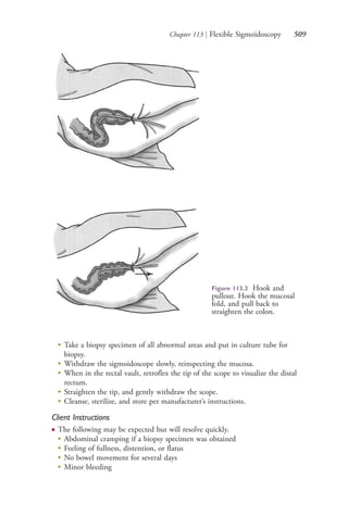 Chapter 113 | Flexible Sigmoidoscopy 509
Figure 113.3 Hook and
pullout. Hook the mucosal
fold, and pull back to
straighten the colon.
●
Take a biopsy specimen of all abnormal areas and put in culture tube for
biopsy.
●
Withdraw the sigmoidoscope slowly, reinspecting the mucosa.
●
When in the rectal vault, retroflex the tip of the scope to visualize the distal
rectum.
●
Straighten the tip, and gently withdraw the scope.
●
Cleanse, sterilize, and store per manufacturer’s instructions.
Client Instructions
● The following may be expected but will resolve quickly.
●
Abdominal cramping if a biopsy specimen was obtained
●
Feeling of fullness, distention, or flatus
●
No bowel movement for several days
●
Minor bleeding
4206_Chapter 7_.indd 5094206_Chapter 7_.indd 509 12/24/2014 2:30:30 PM12/24/2014 2:30:30 PM
Process CyanProcess CyanProcess MagentaProcess MagentaProcess YellowProcess YellowProcess BlackProcess Black
 