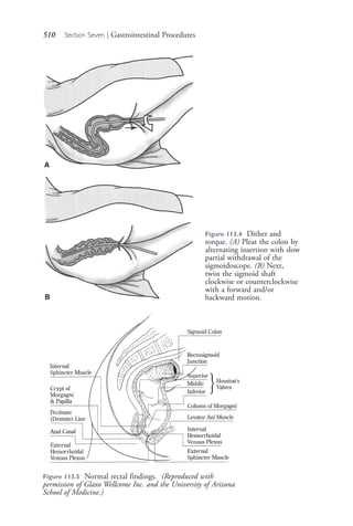 510 Section Seven | Gastrointestinal Procedures
Figure 113.4 Dither and
torque. (A) Pleat the colon by
alternating insertion with slow
partial withdrawal of the
sigmoidoscope. (B) Next,
twist the sigmoid shaft
clockwise or counterclockwise
with a forward and/or
backward motion.
A
B
Figure 113.5 Normal rectal findings. (Reproduced with
permission of Glaxo Wellcome Inc. and the University of Arizona
School of Medicine.)
4206_Chapter 7_.indd 5104206_Chapter 7_.indd 510 12/24/2014 2:30:30 PM12/24/2014 2:30:30 PM
Process CyanProcess CyanProcess MagentaProcess MagentaProcess YellowProcess YellowProcess BlackProcess Black
 