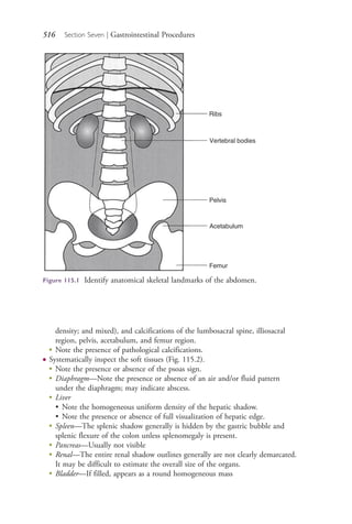 516 Section Seven | Gastrointestinal Procedures
density; and mixed), and calcifications of the lumbosacral spine, illiosacral
region, pelvis, acetabulum, and femur region.
●
Note the presence of pathological calcifications.
● Systematically inspect the soft tissues (Fig. 115.2).
●
Note the presence or absence of the psoas sign.
●
Diaphragm—Note the presence or absence of an air and/or fluid pattern
under the diaphragm; may indicate abscess.
●
Liver
• Note the homogeneous uniform density of the hepatic shadow.
• Note the presence or absence of full visualization of hepatic edge.
●
Spleen—The splenic shadow generally is hidden by the gastric bubble and
splenic flexure of the colon unless splenomegaly is present.
●
Pancreas—Usually not visible
●
Renal—The entire renal shadow outlines generally are not clearly demarcated.
It may be difficult to estimate the overall size of the organs.
●
Bladder—If filled, appears as a round homogeneous mass
Ribs
Vertebral bodies
Pelvis
Acetabulum
Femur
Figure 115.1 Identify anatomical skeletal landmarks of the abdomen.
4206_Chapter 7_.indd 5164206_Chapter 7_.indd 516 12/24/2014 2:30:31 PM12/24/2014 2:30:31 PM
Process CyanProcess CyanProcess MagentaProcess MagentaProcess YellowProcess YellowProcess BlackProcess Black
 