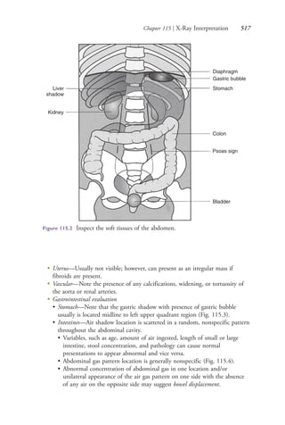 Chapter 115 | X-Ray Interpretation 517
●
Uterus—Usually not visible; however, can present as an irregular mass if
fibroids are present.
●
Vascular—Note the presence of any calcifications, widening, or tortuosity of
the aorta or renal arteries.
●
Gastrointestinal evaluation
• Stomach—Note that the gastric shadow with presence of gastric bubble
usually is located midline to left upper quadrant region (Fig. 115.3).
• Intestines—Air shadow location is scattered in a random, nonspecific pattern
throughout the abdominal cavity.
• Variables, such as age, amount of air ingested, length of small or large
intestine, stool concentration, and pathology can cause normal
presentations to appear abnormal and vice versa.
• Abdominal gas pattern location is generally nonspecific (Fig. 115.4).
• Abnormal concentration of abdominal gas in one location and/or
unilateral appearance of the air gas pattern on one side with the absence
of any air on the opposite side may suggest bowel displacement.
Liver
shadow
Kidney
Diaphragm
Gastric bubble
Stomach
Colon
Psoas sign
Bladder
Figure 115.2 Inspect the soft tissues of the abdomen.
4206_Chapter 7_.indd 5174206_Chapter 7_.indd 517 12/24/2014 2:30:31 PM12/24/2014 2:30:31 PM
Process CyanProcess CyanProcess MagentaProcess MagentaProcess YellowProcess YellowProcess BlackProcess Black
 
