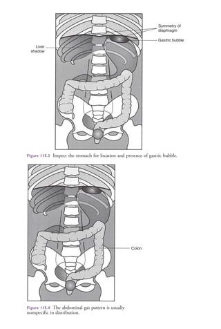 Colon
Figure 115.4 The abdominal gas pattern is usually
nonspecific in distribution.
Liver
shadow
Symmetry of
diaphragm
Gastric bubble
Figure 115.3 Inspect the stomach for location and presence of gastric bubble.
4206_Chapter 7_.indd 5184206_Chapter 7_.indd 518 12/24/2014 2:30:31 PM12/24/2014 2:30:31 PM
Process CyanProcess CyanProcess MagentaProcess MagentaProcess YellowProcess YellowProcess BlackProcess Black
 