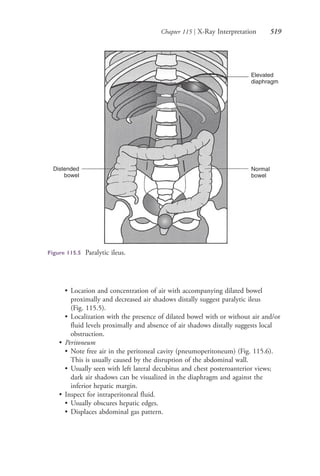Chapter 115 | X-Ray Interpretation 519
Distended
bowel
Elevated
diaphragm
Normal
bowel
Figure 115.5 Paralytic ileus.
• Location and concentration of air with accompanying dilated bowel
proximally and decreased air shadows distally suggest paralytic ileus
(Fig. 115.5).
• Localization with the presence of dilated bowel with or without air and/or
fluid levels proximally and absence of air shadows distally suggests local
obstruction.
• Peritoneum
• Note free air in the peritoneal cavity (pneumoperitoneum) (Fig. 115.6).
This is usually caused by the disruption of the abdominal wall.
• Usually seen with left lateral decubitus and chest posteroanterior views;
dark air shadows can be visualized in the diaphragm and against the
inferior hepatic margin.
• Inspect for intraperitoneal fluid.
• Usually obscures hepatic edges.
• Displaces abdominal gas pattern.
4206_Chapter 7_.indd 5194206_Chapter 7_.indd 519 12/24/2014 2:30:31 PM12/24/2014 2:30:31 PM
Process CyanProcess CyanProcess MagentaProcess MagentaProcess YellowProcess YellowProcess BlackProcess Black
 