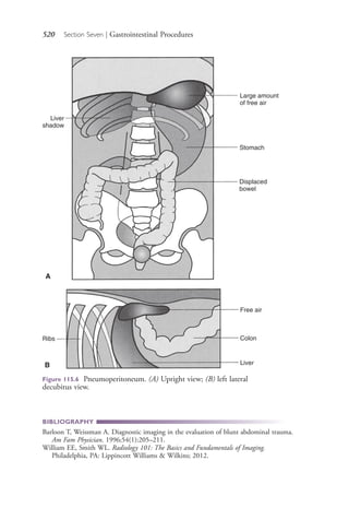 520 Section Seven | Gastrointestinal Procedures
BIBLIOGRAPHY
Barloon T, Weissman A. Diagnostic imaging in the evaluation of blunt abdominal trauma.
Am Fam Physician. 1996;54(1):205–211.
William EE, Smith WL. Radiology 101: The Basics and Fundamentals of Imaging.
Philadelphia, PA: Lippincott Williams & Wilkins; 2012.
Liver
shadow
Large amount
of free air
Stomach
Displaced
bowel
A
Free air
Colon
Liver
Ribs
B
Figure 115.6 Pneumoperitoneum. (A) Upright view; (B) left lateral
decubitus view.
4206_Chapter 7_.indd 5204206_Chapter 7_.indd 520 12/24/2014 2:30:31 PM12/24/2014 2:30:31 PM
Process CyanProcess CyanProcess MagentaProcess MagentaProcess YellowProcess YellowProcess BlackProcess Black
 