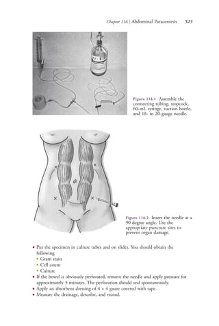 Chapter 116 | Abdominal Paracentesis 523
● Put the specimen in culture tubes and on slides. You should obtain the
following
● Gram stain
● Cell count
● Culture
● If the bowel is obviously perforated, remove the needle and apply pressure for
approximately 5 minutes. The perforation should seal spontaneously.
● Apply an absorbent dressing of 4 × 4 gauze covered with tape.
● Measure the drainage, describe, and record.
Figure 116.1 Assemble the
connecting tubing, stopcock,
60-mL syringe, suction bottle,
and 18- to 20-gauge needle.
Figure 116.2 Insert the needle at a
90-degree angle. Use the
appropriate puncture sites to
prevent organ damage.
4206_Chapter 7_.indd 5234206_Chapter 7_.indd 523 12/24/2014 2:30:32 PM12/24/2014 2:30:32 PM
Process CyanProcess CyanProcess MagentaProcess MagentaProcess YellowProcess YellowProcess BlackProcess Black
 