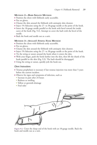 Chapter 9 | Fishhook Removal 39
METHOD 2—BARB SHEATH METHOD
● Position the client with fishhook easily accessible.
● Put on gloves.
● Cleanse the skin around the fishhook with antiseptic skin cleanser.
● Inject 1% lidocaine using the 27- to 30-gauge needle at the point of the hook.
● Insert the 18-gauge needle parallel to the hook with bevel toward the inside
curve of the hook (Fig. 9.2). Attempt to cover the barb with the bevel of the
needle.
● Back the hook and needle out as a unit.
METHOD 3—ANGLER’S STRING-YANK METHOD
● Position the client with fishhook easily accessible.
● Put on gloves.
● Cleanse the skin around the fishhook with antiseptic skin cleanser.
● Inject 1% lidocaine using the 27- to 30-gauge needle at the point of the hook.
● Tie the string or suture around the hook where it enters the skin.
● With your finger, push the hook further into the skin, then lift the shank of the
hook parallel to the skin (Fig. 9.3). The barb should be disengaged.
● Using the string or suture, quickly jerk the hook out.
Client Instructions
● Tetanus prophylaxis is necessary if last tetanus injection was more than 5 years
before the current incident.
● Observe for signs and symptoms of infection, such as
●
Increase in pain after 24 hours
●
Redness or swelling
●
Yellow or greenish drainage
●
Foul odor
Figure 9.2 Cover the sharp end of the hook with an 18-gauge needle. Back the
hook and needle out as a unit.
4206_Chapter 1_0001-0120.indd 394206_Chapter 1_0001-0120.indd 39 12/24/2014 2:01:16 PM12/24/2014 2:01:16 PM
Process CyanProcess CyanProcess MagentaProcess MagentaProcess YellowProcess YellowProcess BlackProcess Black
 