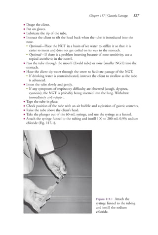 Chapter 117 | Gastric Lavage 527
● Drape the client.
● Put on gloves.
● Lubricate the tip of the tube.
● Instruct the client to tilt the head back when the tube is introduced into the
nose.
●
Optional—Place the NGT in a basin of ice water to stiffen it so that it is
easier to insert and does not get coiled on its way to the stomach.
●
Optional—If there is a problem inserting because of nose sensitivity, use a
topical anesthetic in the nostril.
● Pass the tube through the mouth (Ewald tube) or nose (smaller NGT) into the
stomach.
● Have the client sip water through the straw to facilitate passage of the NGT.
●
If drinking water is contraindicated, instruct the client to swallow as the tube
is advanced.
● Insert the tube slowly and gently.
●
If any symptoms of respiratory difficulty are observed (cough, dyspnea,
cyanosis), the NGT is probably being inserted into the lung. Withdraw
immediately and reinsert.
● Tape the tube in place.
● Check position of the tube with an air bubble and aspiration of gastric contents.
● Raise the tube above the client’s head.
● Take the plunger out of the 60-mL syringe, and use the syringe as a funnel.
● Attach the syringe funnel to the tubing and instill 100 to 200 mL 0.9% sodium
chloride (Fig. 117.1).
Figure 117.1 Attach the
syringe funnel to the tubing
and instill the sodium
chloride.
4206_Chapter 7_.indd 5274206_Chapter 7_.indd 527 12/24/2014 2:30:32 PM12/24/2014 2:30:32 PM
Process CyanProcess CyanProcess MagentaProcess MagentaProcess YellowProcess YellowProcess BlackProcess Black
 