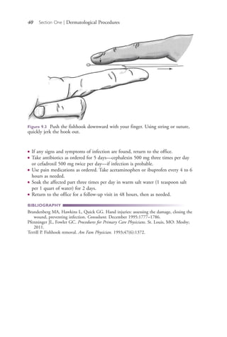40 Section One | Dermatological Procedures
● If any signs and symptoms of infection are found, return to the office.
● Take antibiotics as ordered for 5 days—cephalexin 500 mg three times per day
or cefadroxil 500 mg twice per day—if infection is probable.
● Use pain medications as ordered. Take acetaminophen or ibuprofen every 4 to 6
hours as needed.
● Soak the affected part three times per day in warm salt water (1 teaspoon salt
per 1 quart of water) for 2 days.
● Return to the office for a follow-up visit in 48 hours, then as needed.
BIBLIOGRAPHY
Brandenberg MA, Hawkins L, Quick GG. Hand injuries: assessing the damage, closing the
wound, preventing infection. Consultant. December 1995:1777–1786.
Pfenninger JL, Fowler GC. Procedures for Primary Care Physicians. St. Louis, MO: Mosby;
2011.
Terrill P. Fishhook removal. Am Fam Physician. 1993;47(6):1372.
Figure 9.3 Push the fishhook downward with your finger. Using string or suture,
quickly jerk the hook out.
4206_Chapter 1_0001-0120.indd 404206_Chapter 1_0001-0120.indd 40 12/24/2014 2:01:16 PM12/24/2014 2:01:16 PM
Process CyanProcess CyanProcess MagentaProcess MagentaProcess YellowProcess YellowProcess BlackProcess Black
 