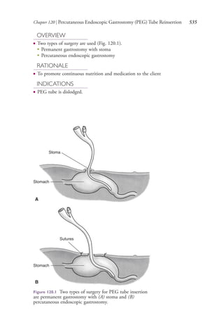 Chapter 120 | Percutaneous Endoscopic Gastrostomy (PEG) Tube Reinsertion 535
OVERVIEW
● Two types of surgery are used (Fig. 120.1).
●
Permanent gastrostomy with stoma
●
Percutaneous endoscopic gastrostomy
RATIONALE
● To promote continuous nutrition and medication to the client
INDICATIONS
● PEG tube is dislodged.
Figure 120.1 Two types of surgery for PEG tube insertion
are permanent gastrostomy with (A) stoma and (B)
percutaneous endoscopic gastrostomy.
Stoma
Stomach
A
Stomach
Sutures
B
4206_Chapter 7_.indd 5354206_Chapter 7_.indd 535 12/24/2014 2:30:32 PM12/24/2014 2:30:32 PM
Process CyanProcess CyanProcess MagentaProcess MagentaProcess YellowProcess YellowProcess BlackProcess Black
 