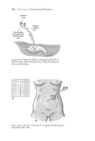 538 Section Seven | Gastrointestinal Procedures
Tube feeding
and medication
administration
port
Balloon
inflation
port
Catheter
plug
Figure 120.4 Inflate the balloon and gently pull back on
the PEG tube until resistance is met. Plug the large port
with a catheter plug.
A
B
Figure 120.5 (A) Cut a slit in the 4 × 4 gauze and (B) secure it
around the PEG tube.
4206_Chapter 7_.indd 5384206_Chapter 7_.indd 538 12/24/2014 2:30:32 PM12/24/2014 2:30:32 PM
Process CyanProcess CyanProcess MagentaProcess MagentaProcess YellowProcess YellowProcess BlackProcess Black
 
