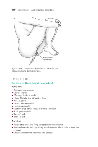 550 Section Seven | Gastrointestinal Procedures
PROCEDURE
Removal of Thrombosed Hemorrhoid
Equipment
● Antiseptic skin cleanser
● Gloves—sterile
● 27-gauge, 1½-inch needle
● 1% or 2% lidocaine with epinephrine
● No. 11 scalpel
● Curved scissors—sterile
● Hemostats—sterile
● Cautery, silver nitrate sticks, or Monsel’s solution
● 4 × 4 gauze—sterile
● Tape—3 inch
● Tape—1 inch
Procedure
● Position the client side lying with thrombosed side down.
● Separate buttocks, and tape (using 3-inch tape) to side of table to keep area
exposed.
● Cleanse the area with antiseptic skin cleanser.
Thrombosed
hemorrhoid
Figure 125.1 Thrombosed hemorrhoid. Infiltrate with
lidocaine around the hemorrhoid.
4206_Chapter 7_.indd 5504206_Chapter 7_.indd 550 12/24/2014 2:30:33 PM12/24/2014 2:30:33 PM
Process CyanProcess CyanProcess MagentaProcess MagentaProcess YellowProcess YellowProcess BlackProcess Black
 