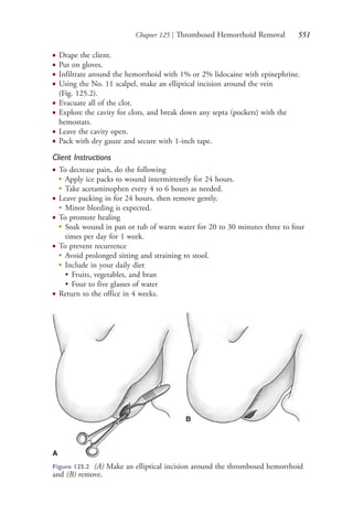 Chapter 125 | Thrombosed Hemorrhoid Removal 551
● Drape the client.
● Put on gloves.
● Infiltrate around the hemorrhoid with 1% or 2% lidocaine with epinephrine.
● Using the No. 11 scalpel, make an elliptical incision around the vein
(Fig. 125.2).
● Evacuate all of the clot.
● Explore the cavity for clots, and break down any septa (pockets) with the
hemostats.
● Leave the cavity open.
● Pack with dry gauze and secure with 1-inch tape.
Client Instructions
● To decrease pain, do the following
●
Apply ice packs to wound intermittently for 24 hours.
●
Take acetaminophen every 4 to 6 hours as needed.
● Leave packing in for 24 hours, then remove gently.
●
Minor bleeding is expected.
● To promote healing
●
Soak wound in pan or tub of warm water for 20 to 30 minutes three to four
times per day for 1 week.
● To prevent recurrence
●
Avoid prolonged sitting and straining to stool.
●
Include in your daily diet
• Fruits, vegetables, and bran
• Four to five glasses of water
● Return to the office in 4 weeks.
A
B
Figure 125.2 (A) Make an elliptical incision around the thrombosed hemorrhoid
and (B) remove.
4206_Chapter 7_.indd 5514206_Chapter 7_.indd 551 12/24/2014 2:30:33 PM12/24/2014 2:30:33 PM
Process CyanProcess CyanProcess MagentaProcess MagentaProcess YellowProcess YellowProcess BlackProcess Black
 