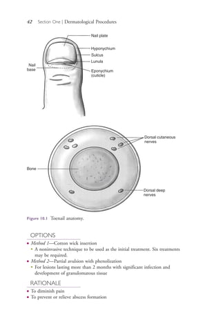 42 Section One | Dermatological Procedures
OPTIONS
● Method 1—Cotton wick insertion
●
A noninvasive technique to be used as the initial treatment. Six treatments
may be required.
● Method 2—Partial avulsion with phenolization
● For lesions lasting more than 2 months with significant infection and
development of granulomatous tissue
RATIONALE
● To diminish pain
● To prevent or relieve abscess formation
Nail plate
Hyponychium
Sulcus
Lunula
Eponychium
(cuticle)
Nail
base
Dorsal cutaneous
nerves
Dorsal deep
nerves
Bone
Figure 10.1 Toenail anatomy.
4206_Chapter 1_0001-0120.indd 424206_Chapter 1_0001-0120.indd 42 12/24/2014 2:01:16 PM12/24/2014 2:01:16 PM
Process CyanProcess CyanProcess MagentaProcess MagentaProcess YellowProcess YellowProcess BlackProcess Black
 
