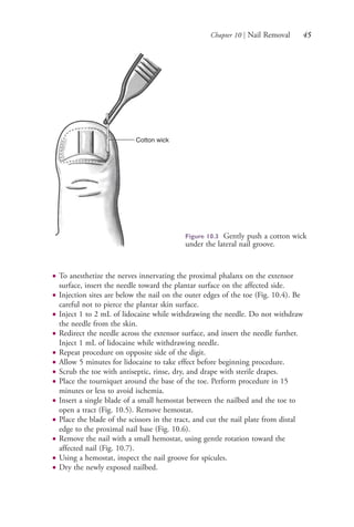Chapter 10 | Nail Removal 45
● To anesthetize the nerves innervating the proximal phalanx on the extensor
surface, insert the needle toward the plantar surface on the affected side.
● Injection sites are below the nail on the outer edges of the toe (Fig. 10.4). Be
careful not to pierce the plantar skin surface.
● Inject 1 to 2 mL of lidocaine while withdrawing the needle. Do not withdraw
the needle from the skin.
● Redirect the needle across the extensor surface, and insert the needle further.
Inject 1 mL of lidocaine while withdrawing needle.
● Repeat procedure on opposite side of the digit.
● Allow 5 minutes for lidocaine to take effect before beginning procedure.
● Scrub the toe with antiseptic, rinse, dry, and drape with sterile drapes.
● Place the tourniquet around the base of the toe. Perform procedure in 15
minutes or less to avoid ischemia.
● Insert a single blade of a small hemostat between the nailbed and the toe to
open a tract (Fig. 10.5). Remove hemostat.
● Place the blade of the scissors in the tract, and cut the nail plate from distal
edge to the proximal nail base (Fig. 10.6).
● Remove the nail with a small hemostat, using gentle rotation toward the
affected nail (Fig. 10.7).
● Using a hemostat, inspect the nail groove for spicules.
● Dry the newly exposed nailbed.
Cotton wick
Figure 10.3 Gently push a cotton wick
under the lateral nail groove.
4206_Chapter 1_0001-0120.indd 454206_Chapter 1_0001-0120.indd 45 12/24/2014 2:01:16 PM12/24/2014 2:01:16 PM
Process CyanProcess CyanProcess MagentaProcess MagentaProcess YellowProcess YellowProcess BlackProcess Black
 