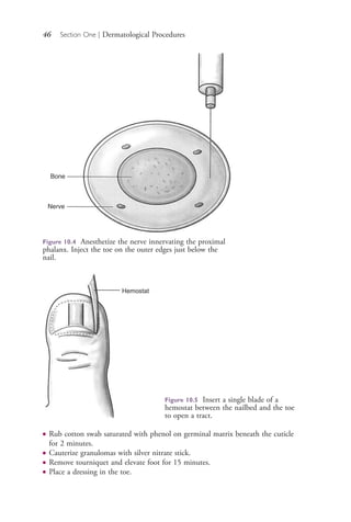 46 Section One | Dermatological Procedures
Bone
Nerve
Figure 10.4 Anesthetize the nerve innervating the proximal
phalanx. Inject the toe on the outer edges just below the
nail.
Hemostat
Figure 10.5 Insert a single blade of a
hemostat between the nailbed and the toe
to open a tract.
● Rub cotton swab saturated with phenol on germinal matrix beneath the cuticle
for 2 minutes.
● Cauterize granulomas with silver nitrate stick.
● Remove tourniquet and elevate foot for 15 minutes.
● Place a dressing in the toe.
4206_Chapter 1_0001-0120.indd 464206_Chapter 1_0001-0120.indd 46 12/24/2014 2:01:16 PM12/24/2014 2:01:16 PM
Process CyanProcess CyanProcess MagentaProcess MagentaProcess YellowProcess YellowProcess BlackProcess Black
 
