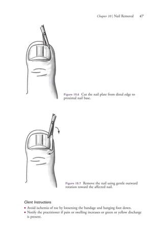 Chapter 10 | Nail Removal 47
Client Instructions
● Avoid ischemia of toe by loosening the bandage and hanging foot down.
● Notify the practitioner if pain or swelling increases or green or yellow discharge
is present.
Figure 10.6 Cut the nail plate from distal edge to
proximal nail base.
Figure 10.7 Remove the nail using gentle outward
rotation toward the affected nail.
4206_Chapter 1_0001-0120.indd 474206_Chapter 1_0001-0120.indd 47 12/24/2014 2:01:16 PM12/24/2014 2:01:16 PM
Process CyanProcess CyanProcess MagentaProcess MagentaProcess YellowProcess YellowProcess BlackProcess Black
 
