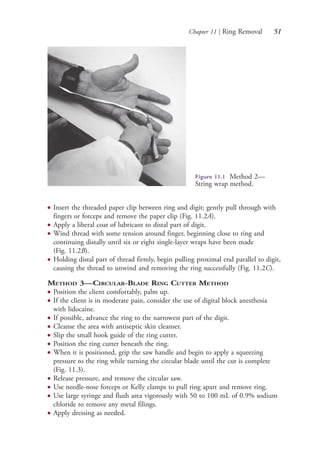Chapter 11 | Ring Removal 51
● Insert the threaded paper clip between ring and digit; gently pull through with
fingers or forceps and remove the paper clip (Fig. 11.2A).
● Apply a liberal coat of lubricant to distal part of digit.
● Wind thread with some tension around finger, beginning close to ring and
continuing distally until six or eight single-layer wraps have been made
(Fig. 11.2B).
● Holding distal part of thread firmly, begin pulling proximal end parallel to digit,
causing the thread to unwind and removing the ring successfully (Fig. 11.2C).
METHOD 3—CIRCULAR-BLADE RING CUTTER METHOD
● Position the client comfortably, palm up.
● If the client is in moderate pain, consider the use of digital block anesthesia
with lidocaine.
● If possible, advance the ring to the narrowest part of the digit.
● Cleanse the area with antiseptic skin cleanser.
● Slip the small hook guide of the ring cutter.
● Position the ring cutter beneath the ring.
● When it is positioned, grip the saw handle and begin to apply a squeezing
pressure to the ring while turning the circular blade until the cut is complete
(Fig. 11.3).
● Release pressure, and remove the circular saw.
● Use needle-nose forceps or Kelly clamps to pull ring apart and remove ring.
● Use large syringe and flush area vigorously with 50 to 100 mL of 0.9% sodium
chloride to remove any metal filings.
● Apply dressing as needed.
Figure 11.1 Method 2—
String wrap method.
4206_Chapter 1_0001-0120.indd 514206_Chapter 1_0001-0120.indd 51 12/24/2014 2:01:16 PM12/24/2014 2:01:16 PM
Process CyanProcess CyanProcess MagentaProcess MagentaProcess YellowProcess YellowProcess BlackProcess Black
 