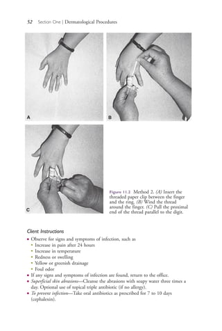 52 Section One | Dermatological Procedures
Figure 11.2 Method 2. (A) Insert the
threaded paper clip between the finger
and the ring. (B) Wind the thread
around the finger. (C) Pull the proximal
end of the thread parallel to the digit.
A B
C
Client Instructions
● Observe for signs and symptoms of infection, such as
●
Increase in pain after 24 hours
●
Increase in temperature
●
Redness or swelling
●
Yellow or greenish drainage
●
Foul odor
● If any signs and symptoms of infection are found, return to the office.
● Superficial skin abrasions—Cleanse the abrasions with soapy water three times a
day. Optional use of topical triple antibiotic (if no allergy).
● To prevent infection—Take oral antibiotics as prescribed for 7 to 10 days
(cephalexin).
4206_Chapter 1_0001-0120.indd 524206_Chapter 1_0001-0120.indd 52 12/24/2014 2:01:17 PM12/24/2014 2:01:17 PM
Process CyanProcess CyanProcess MagentaProcess MagentaProcess YellowProcess YellowProcess BlackProcess Black
 