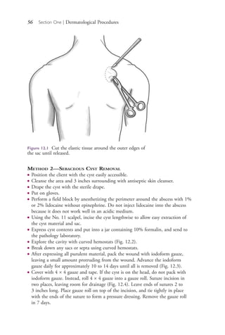 56 Section One | Dermatological Procedures
METHOD 2—SEBACEOUS CYST REMOVAL
● Position the client with the cyst easily accessible.
● Cleanse the area and 3 inches surrounding with antiseptic skin cleanser.
● Drape the cyst with the sterile drape.
● Put on gloves.
● Perform a field block by anesthetizing the perimeter around the abscess with 1%
or 2% lidocaine without epinephrine. Do not inject lidocaine into the abscess
because it does not work well in an acidic medium.
● Using the No. 11 scalpel, incise the cyst lengthwise to allow easy extraction of
the cyst material and sac.
● Express cyst contents and put into a jar containing 10% formalin, and send to
the pathology laboratory.
● Explore the cavity with curved hemostats (Fig. 12.2).
● Break down any sacs or septa using curved hemostats.
● After expressing all purulent material, pack the wound with iodoform gauze,
leaving a small amount protruding from the wound. Advance the iodoform
gauze daily for approximately 10 to 14 days until all is removed (Fig. 12.3).
● Cover with 4 × 4 gauze and tape. If the cyst is on the head, do not pack with
iodoform gauze. Instead, roll 4 × 4 gauze into a gauze roll. Suture incision in
two places, leaving room for drainage (Fig. 12.4). Leave ends of sutures 2 to
3 inches long. Place gauze roll on top of the incision, and tie tightly in place
with the ends of the suture to form a pressure dressing. Remove the gauze roll
in 7 days.
Figure 12.1 Cut the elastic tissue around the outer edges of
the sac until released.
4206_Chapter 1_0001-0120.indd 564206_Chapter 1_0001-0120.indd 56 12/24/2014 2:01:17 PM12/24/2014 2:01:17 PM
Process CyanProcess CyanProcess MagentaProcess MagentaProcess YellowProcess YellowProcess BlackProcess Black
 