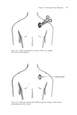 Chapter 12 | Sebaceous Cyst Removal 57
Figure 12.2 After expressing the contents of the cyst, explore
the cavity with hemostats.
Iodoform gauze
Figure 12.3 Pack the wound with iodoform gauze, leaving a small amount
protruding from the wound.
4206_Chapter 1_0001-0120.indd 574206_Chapter 1_0001-0120.indd 57 12/24/2014 2:01:17 PM12/24/2014 2:01:17 PM
Process CyanProcess CyanProcess MagentaProcess MagentaProcess YellowProcess YellowProcess BlackProcess Black
 